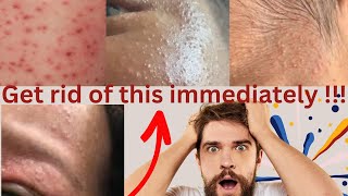 Gderm cream get rid of skin rashes pimples heat rash small Bumps amp more very effective 💯 [upl. by Aronow]