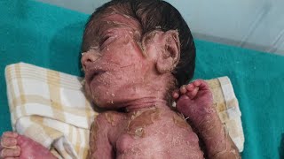 Staphylococcal Scalded Skin Syndrome [upl. by Englis]