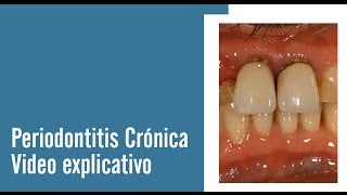 Periodontitis Crónica  Juan Salgado  Enfermedades Periodontales  Video explicativo [upl. by Saenihp]