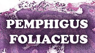 LE PEMPHIGUS FOLIACE  PATHOLOGIE [upl. by Sarene]