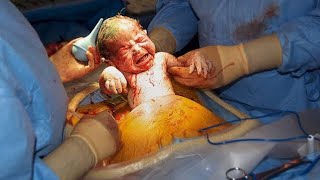 Csection Cesarean Delivery [upl. by Baggott]