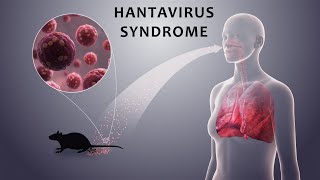 Hantavirus Syndrome [upl. by Boothman903]