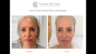 Dermal Filler Morpheus8 Before amp After Instant Result After Filler  The Cosmetic Skin Clinic [upl. by Aimac]