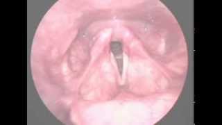 Vocal fold paralysis [upl. by Anyer]