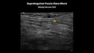 Suprainguinal Fascia Iliaca Block [upl. by Seif]