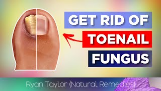 Top 3 Remedies for Toenail Fungus [upl. by Adnawak]