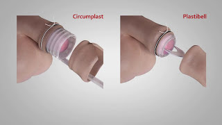 A comparison of Circumplast® and Plastibell® Circumcision Devices [upl. by Eicrad]