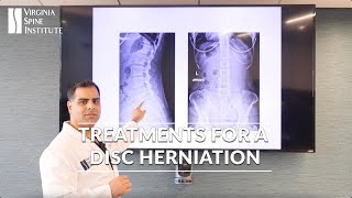 Treatments for a Disc Herniation Caused by Discogenic Back Pain [upl. by Rufus129]