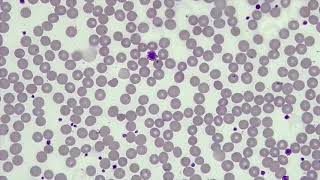 WBC Differential WBCPLT Estimate RBC Morphology [upl. by Llerrom]