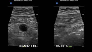 Urachal Cyst causing Acute Abdominal Pain in Adolescent Female [upl. by Silrak]