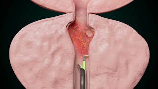 The Best Treatment for Enlarged Prostate Prostate Artery Embolization [upl. by Ladew]