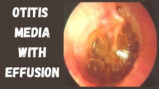 Otitis Media With Effusion OME  Glue Ear [upl. by Eciruam534]