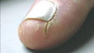 DermTV  How to Heal Cracked Fingertips DermTVcom Epi 125 [upl. by Arres985]