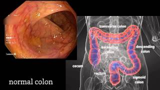 Colonoscopy A Journey Though the Colon and Removal of Polyps [upl. by Nissy]