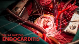 Signs and Symptoms of Endocarditis Mnemonic [upl. by Aicilec]