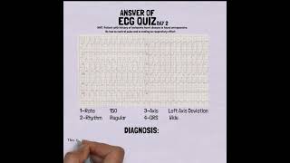 ANSWER ECG QUIZ DAY 2 [upl. by Boice192]