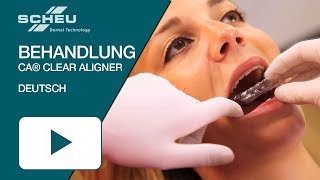 Katharinas erfolgreiche CA® CLEAR ALIGNER Behandlung [upl. by Yukio847]