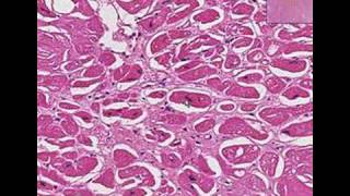 Histopathology Heart Amyloidosis [upl. by Yoshio]