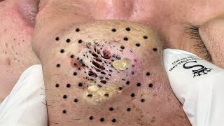 Blackhead Removal With Sac Dep Spa 1000339 [upl. by Albright]