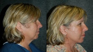 Local Anesthesia Lower Facelift on 61 Year Old Nurse  lowerfacelift [upl. by Collar94]