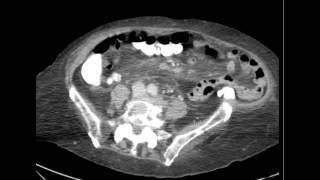 CT Endometrial carcinioma DISCUSSION by a Radiologist [upl. by Auvil]