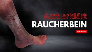 Arzt erklärt das Raucherbein 👨‍⚕️🦵 [upl. by Grazia286]