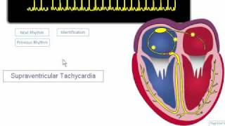 ECG Rhythm Review SVT Atrial Fibrillation Atrial Flutter [upl. by Bondon]