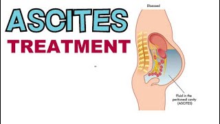 HOW TO TREAT ASCITES FAST ASCITES TREATMENT OPTIONS [upl. by Roselyn]