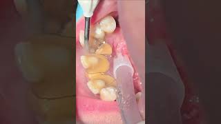 Scaling and cleaning teeth dentist dentista dental tartar calculus [upl. by Solorac]