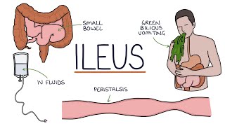 Understanding Ileus Paralytic Ileus [upl. by Nelleus674]