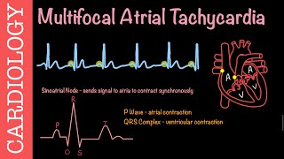 Multifocal Atrial Tachycardia  Cardiovascular Pathophysiology [upl. by Eiahpets]