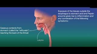 What is silent reflux and what can be done to relieve symptoms [upl. by Dennison]