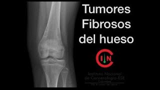 Tumores fibrosos de hueso Dr Carlos Carranza U Militar [upl. by Ely]