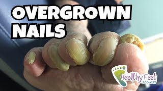 Overgrown Toe Nails [upl. by Cathi]