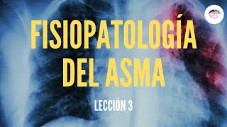 3 FISIOPATOLOGÍA DEL ASMA FISIOPATOLOGÍA RESPIRATORIA [upl. by Charles]