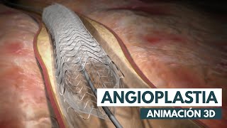 Procedimiento de Stent Paso a paso  Angiolastia  Animación 3D [upl. by Lamraj]