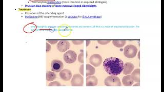 Sideroblastic AnemiaMicrocytic Anemia [upl. by Alenson]