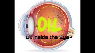 13 How long can you leave Silicone Oil inside the eye RETINAL DETACHMENT retinaldetachment [upl. by Leinoto397]