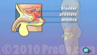 PreOp® Patient Education TURP Transurethral Resection ProstatePenis [upl. by Enytsirhc]