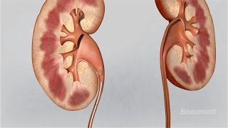 Kidney Stones Symptoms and Treatments [upl. by Dedra]