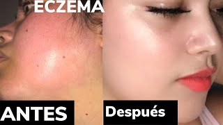 Eczema o que é O que fazer DraNatasha Ferraroni Alergista e Imunologista explica [upl. by Adnylg]