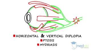 Ophthalmology – Diplopia By Martin ten Hove MD [upl. by Aroda]