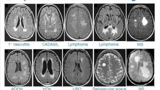 MRI Uses in MS [upl. by Muryh]