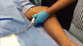 Supine popliteal block a new simple ultrasound guided technique [upl. by Roid]