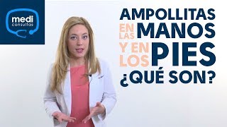 Ampollitas en las manos y los pies ¿qué puedo hacer MediConsultas [upl. by Haodnanehs461]