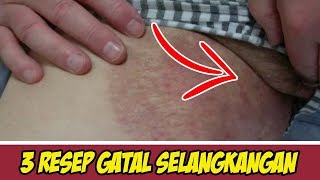 TIDAK PERLU KE DOKTER GATALGATAL DI SELANK KHANGAN SEMBUH TOTAL DENGAN 3 RESEP INI  SEHAT TUBE [upl. by Sausa]