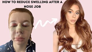 How to reduce swelling after Rhinoplasty  Antonia Higham [upl. by Naugal]