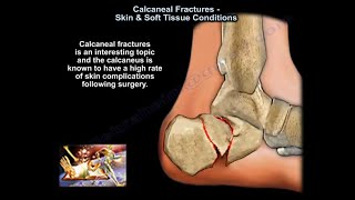 Calcaneal Fractures Skin amp Soft Tissue Condition  Everything You Need To Know  Dr Nabil Ebraheim [upl. by Soisatsana]