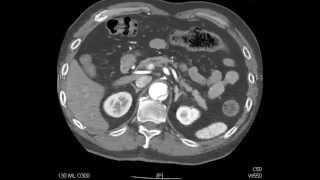 Aortic Dissection  QMH AED Ultrasound Casebook 201409 Video 7 [upl. by Eerolam]