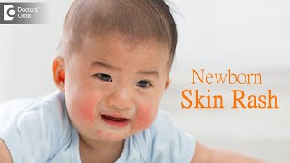 Skin Rash in Newborn  Dr Harish C  Doctors Circle [upl. by Olivier122]